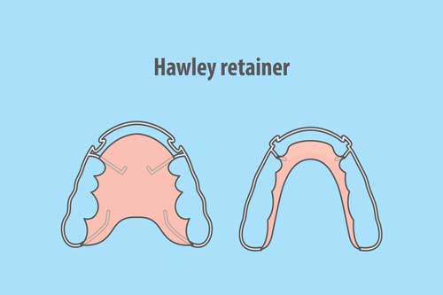 Hawley-Retainer [©paladjal, fotolia.com]